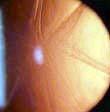 subcapsular cataract Match