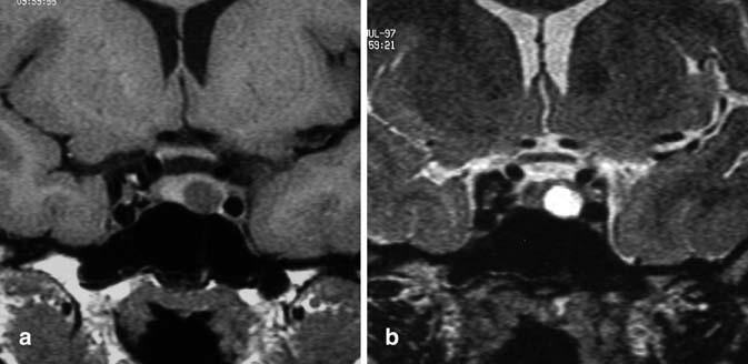 544 Fig. 1 Microprolactinoma. On coronal SE T1-weighted image a the pituitary adenoma is hypointense compared with the unaffected anterior pituitary.