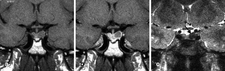 triangular intrasellar lesions, with loss of signal intensity compared to the unaffected anterior pituitary gland.