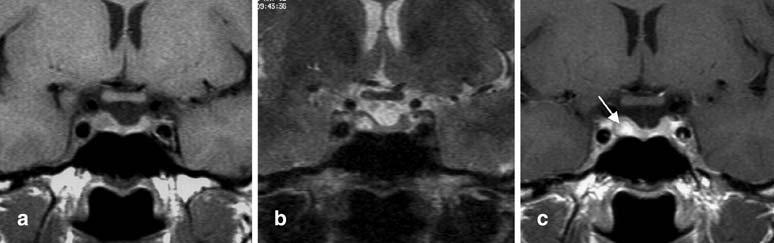 545 Fig. 3 Right-sided microprolactinoma. The pituitary adenoam appears slightly hypointense on SE T1-weighted image a and hyperintense on Turbo T2- weighted image b.