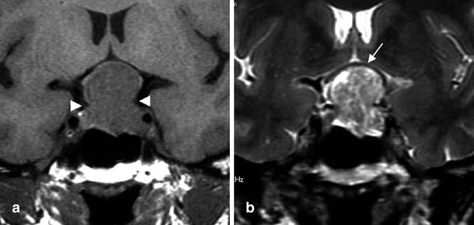 546 Fig. 5 Macroprolactinoma with suprasellar extension. a Coronal SE T1-weighted and b T2- weighted images. Note the figure eight appearance due the sellar diaphragm (arrowheads).