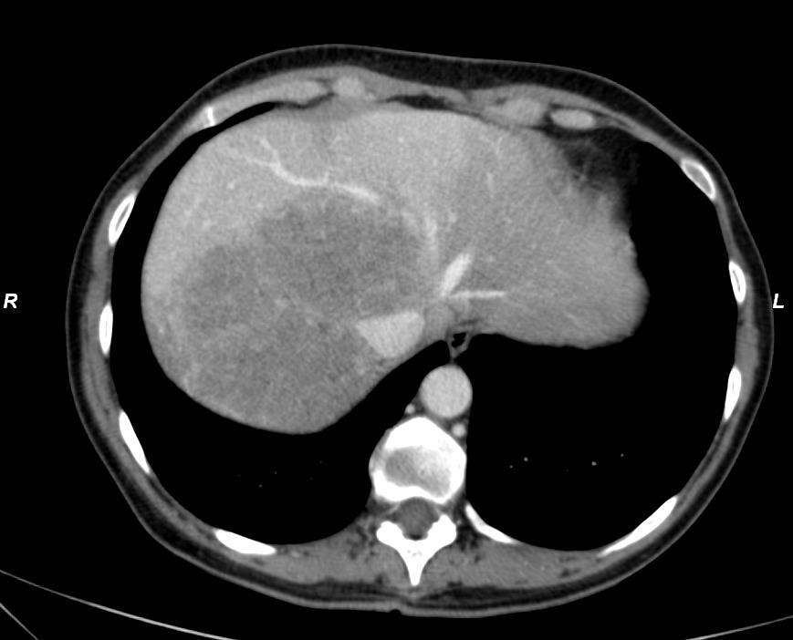Liver first Resectable liver metastases advanced