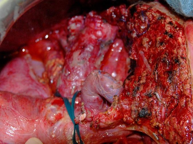 partial peritonectomy in pelvis; loop ileostomy