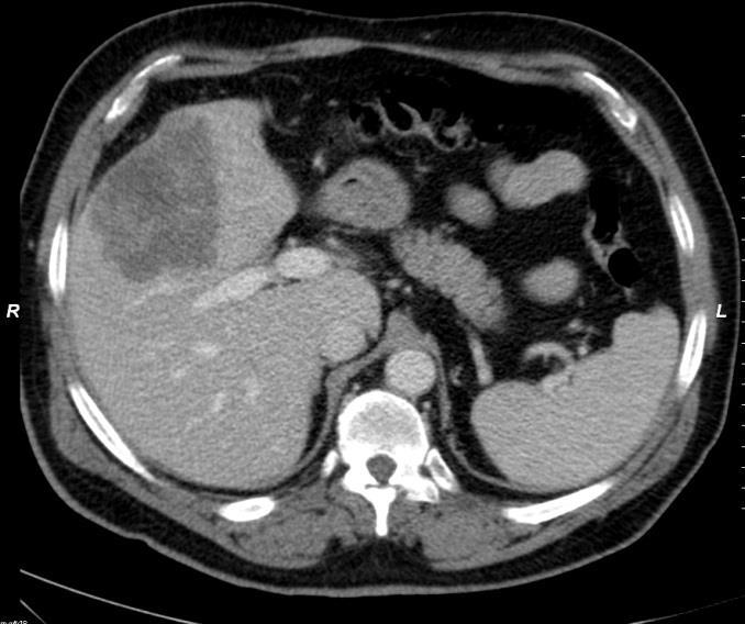 47 year-old male patient rectal cancer: primary