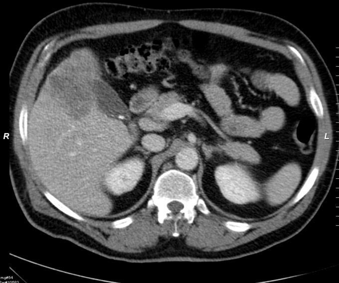 un1; M1 (hep) Resectable liver metastases Liver