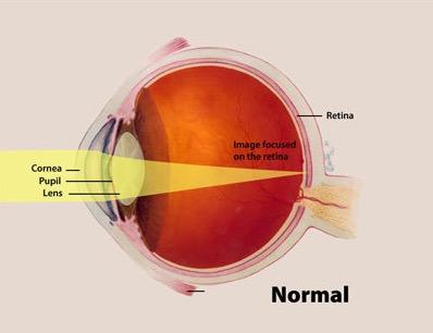 The myopic eyeball is less spherical than the normal eyeball, and is more stretched out lengthways. The length of the eyeball is such that the light focuses at a point in front of the retina.