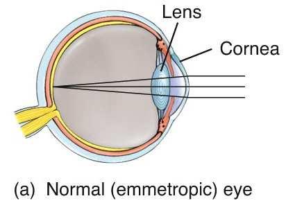 The normal (emmetropic) eye will refract light correctly and focus a clear image on the retina.