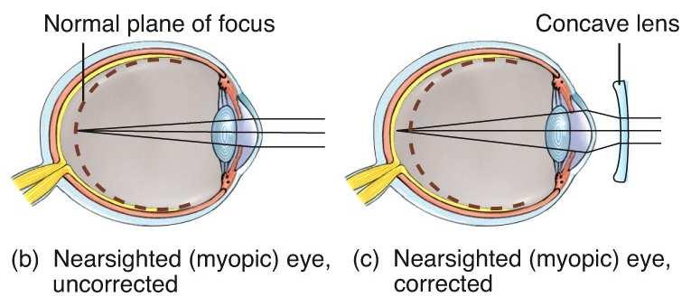 converges (narrows down to a sharp focal point) in front of the retina.