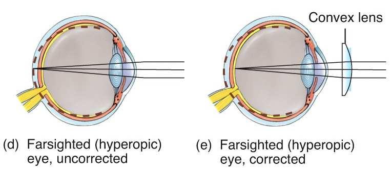 In cases of hyperopia (farsightedness) also known as hypermetropia, the eyeball is shorter than it should be and the image converges behind the retina.