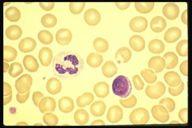 RED BLOOD CELLS Introduction! Normal - Anucleate, highly flexible biconcave discs, 80-100 femtoliters in volume!