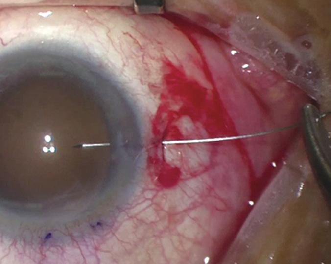 without conjunctival dissection (Fig. 1B and 1C).