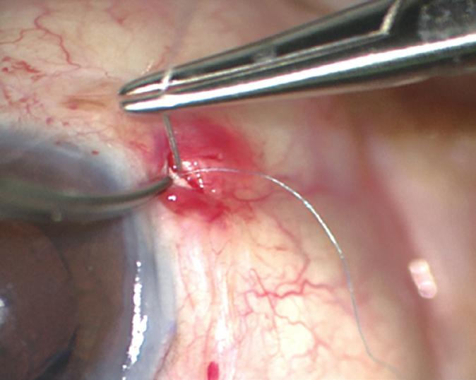 5 mm behind the limbus into the posterior chamber along with the docking of the prolene suture needle using a 26-gauge