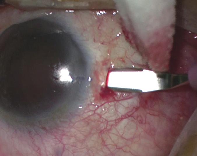 Prolene sutures were exteriorized through the CCI pocket with a hook and the anterior chamber filled with an ophthalmic