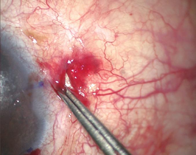Sutureless intrascleral pocket technique for transscleral fixation of intraocular lens (IOL).