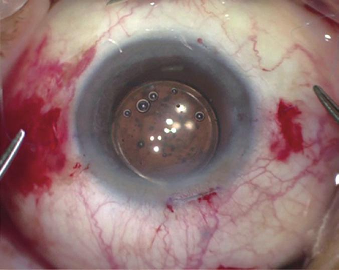 crescent blade without conjunctival dissection (B,C).