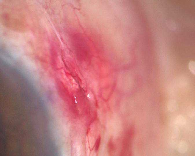 A 2.8-mm clear corneal incision (CCI) made in the anterior limbus using a keratome.