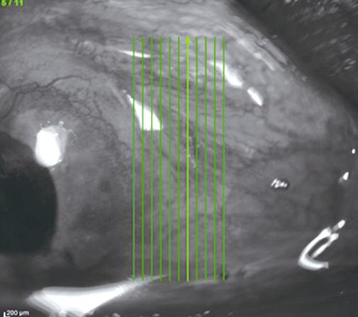 Case summary Four patients who experienced vitrectomy were selected and underwent operation using a sutureless intrascleral pocket technique of transscleral sulcus fixation of IOL.