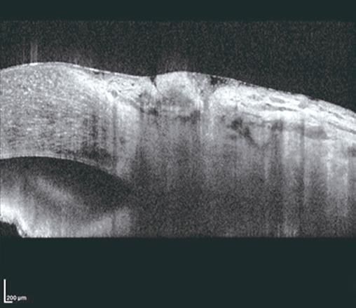 first described the scleral fixation technique of PCIOLs in an aphakic patient, this method has frequently been used in eyes with inadequate posterior capsular or zonular support.