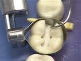 Preparation of tooth 4.
