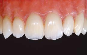 Working with ZrO 2 and Zirox Indications and contraindications ZIROX veneering ceramic is suitable for all densely veneering hard-sintered all-ceramic substructures based on ZrO 2 (zirconium oxide)