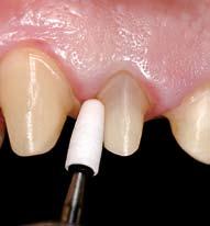 Additional information for dentists Recommendations for handling all-ceramic restorations in zirconium oxide Contraindications If space is restricted or in the case of patients with parafunctional