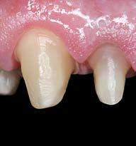 Preparation Due to the physical properties of the zirconium oxide material, the tooth must be prepared with a pronounced chamfer or shoulder.