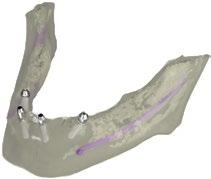 IMPROVED SUPPORT FOR EDENTULOUS Automatic placement of correctly angulated screw-retained abutments