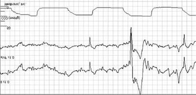 LEVEL B A I P EtCO 2 MONITORING/CAPNOGRAPHY 4. A shark-fin shape (EXAMPLE 3) instead of the normal box-like waveform recognizes the bronchospastic capnography waveform.