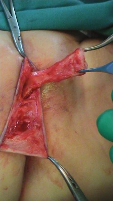of the cyst to create a caudally based flap from the