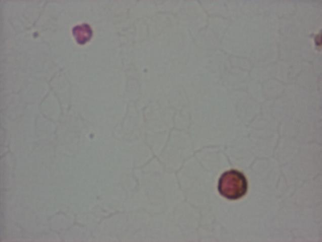 Fig 1.4.1: Anti-FMRP testing specific immunohistochemical staining done on blood smear (left) and on hair root (right).