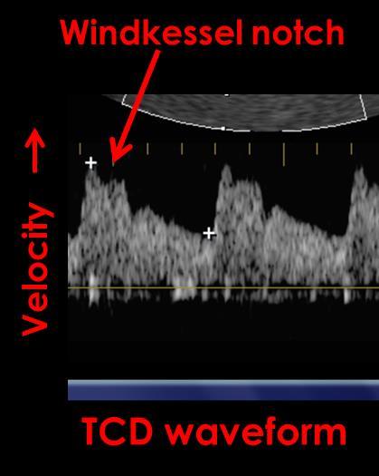 1.D. Measures the mean flow velocity through the cerebral vessels Using the Doppler