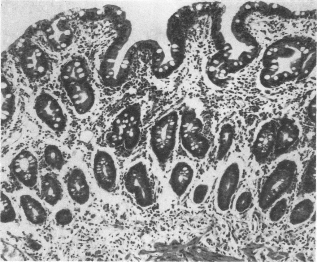 Coeliac disease, adenocarcinoma ofjejunum and in situ squamous carcinoma of oesophagus 63 Fig.