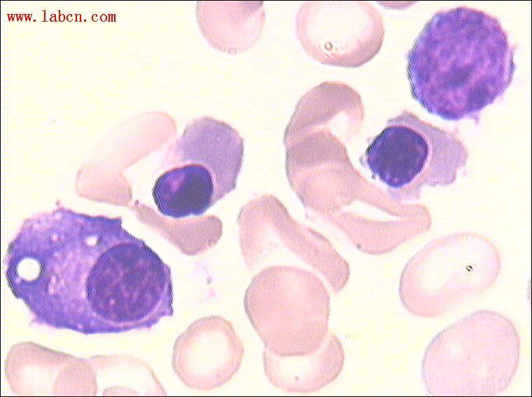 In pure red cell aplasia (PRCA), only the erythroid line is affected characterized by
