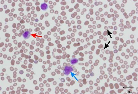 Peripheral blood smear showing leuko-erythroblastic reaction: teardrop