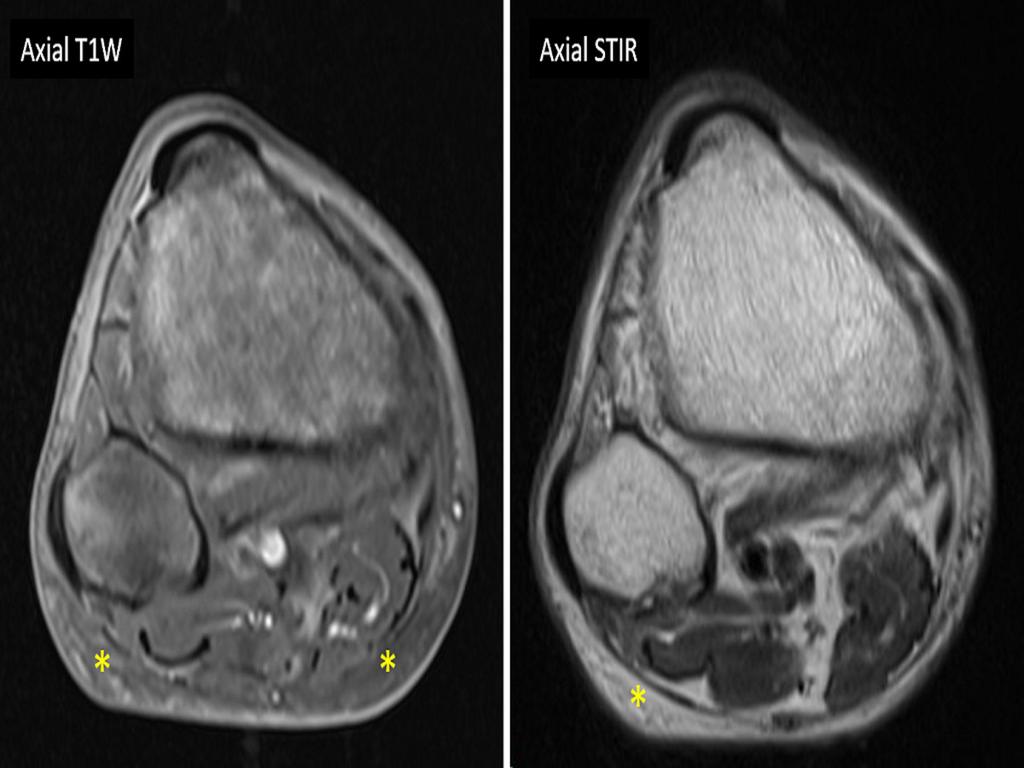 Fig. 5: Selected images from MRI right calf of a 54-year-old man with medical history of alcoholism, alcohol-induced pancreatitis and poorly controlled diabetes.