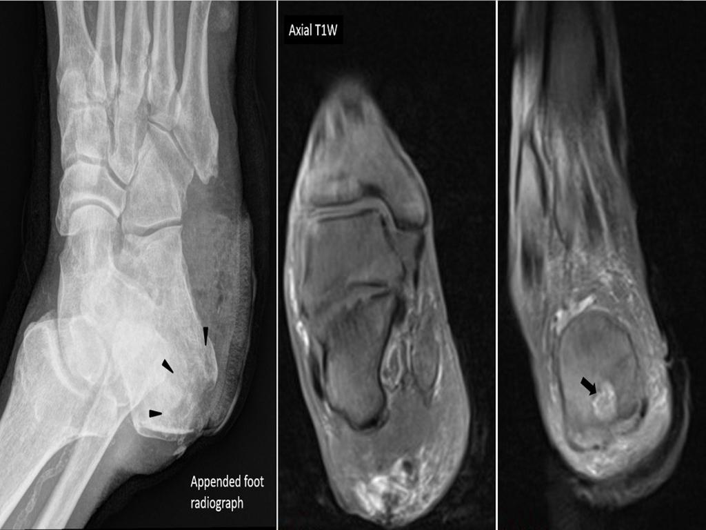 Fig. 6: Large FOV Coronal STIR image of the same patient in Fig 5 reveals diffusely raised marrow signal in both lower limbs, including the partially imaged talar and calcaneal bones.