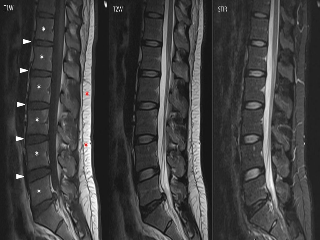 Fig. 1: MRI lumbar spine of a 20-year-old man on T1W, T2W and STIR sequences.