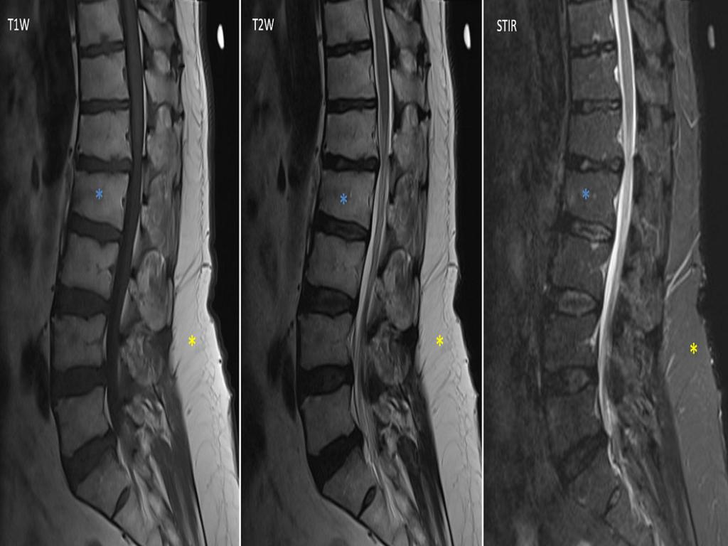 Fig. 2: MRI lumbar spine of a 68-year-old man on T1W, T2W and STIR sequences.