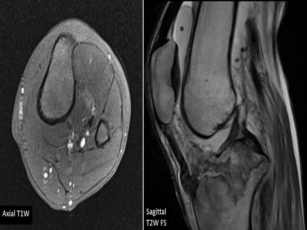 Fig. 3: Selected images from MRI left knee of a 30-year-old man with poorly controlled diabetes. He presented following a fall and was unable to weight-bear on his left leg.