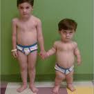Dwarfism Achondroplastic dwarfism long bones stop growing in childhood