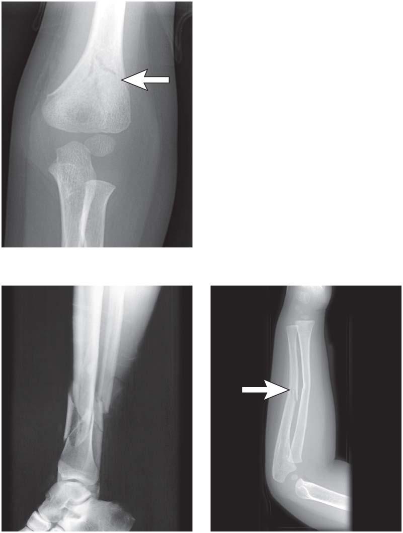 Types of Bone Fractures (a)