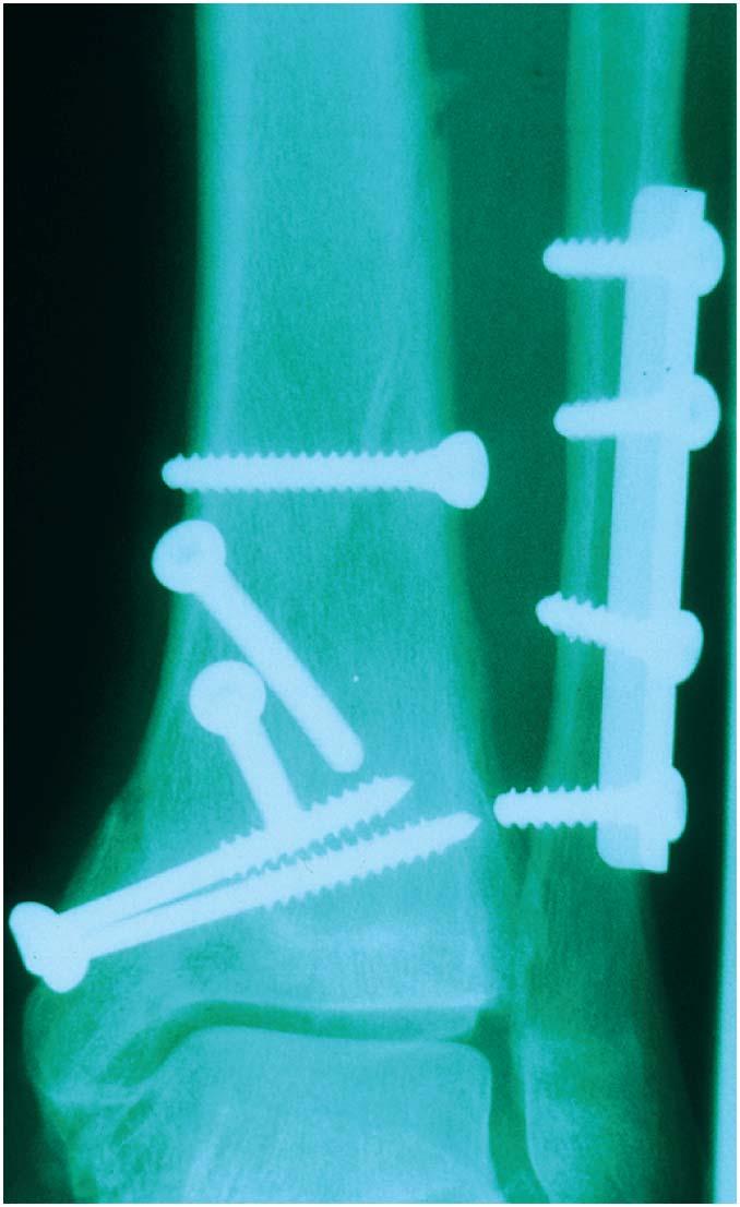 X-Ray of