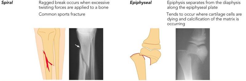 the bone is twisted as it breaks; a common sports fracture epiphyseal - the epiphysis separates from