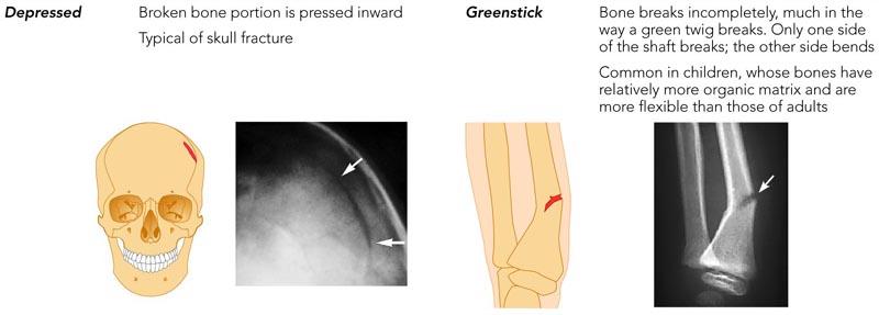 still growing 2) depressed - broken bone is pressed inward Greenstick (hairline) - bone breaks