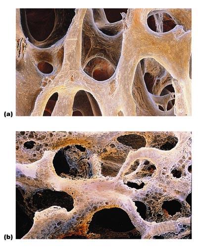 point. 6-49 Bone Disorders OSTEOPOROSIS (fig. 6.14) - characterized by low bone mass; bone reabsorption outpaces bone deposition; occurs most often in women after menopause Osteomalacia vs.