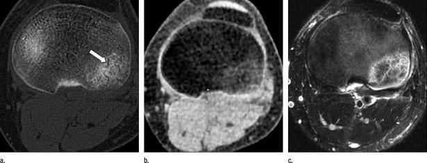 DE Imaging of BME Challenging in conventional CT Partial volume effect from