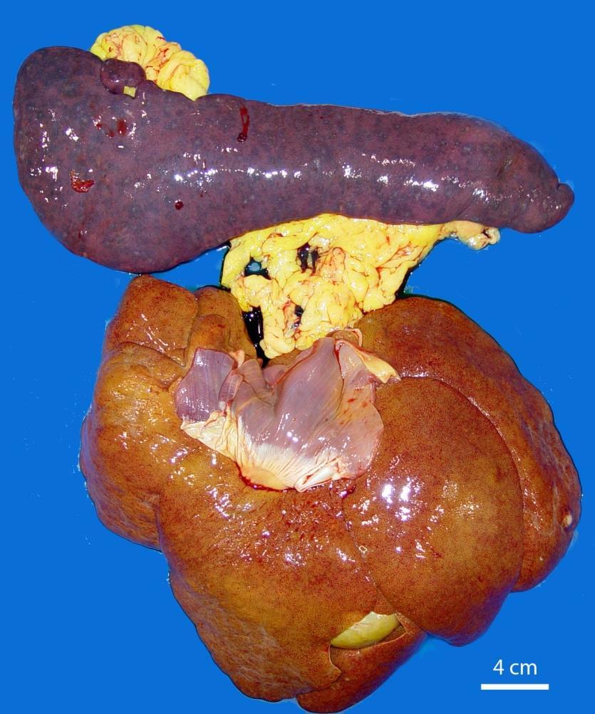 lung, skin Splenomegaly, hepatomegaly Courtesy