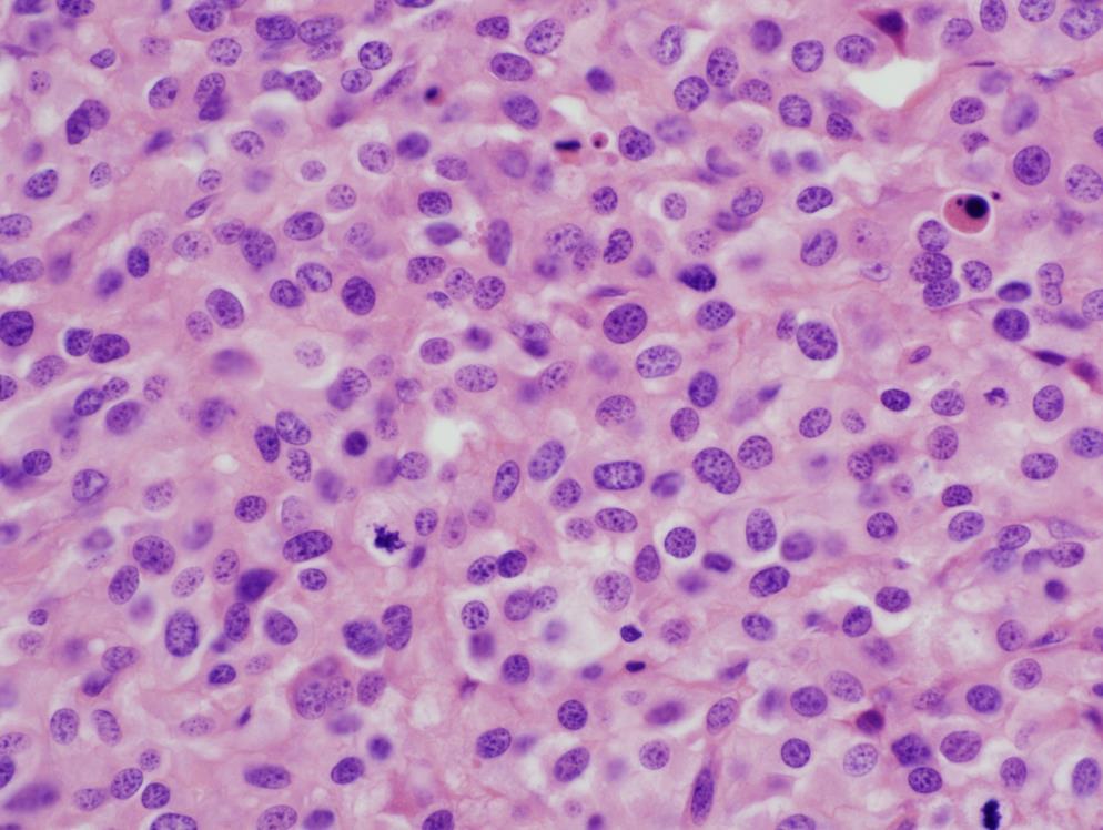 hemophagocytic causing a non-regenerative anemia