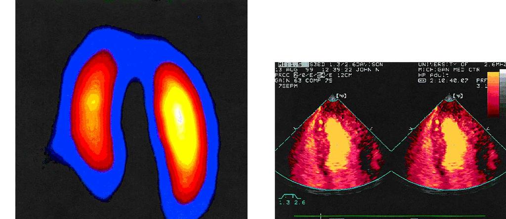 MULTIPLE FRAME TRIGGERING Figure 4. A. Harmonic Angio MFT in a patient with a known apical perfusion defect by SPECT imaging using a continuous infusion of Optison resulted in B.