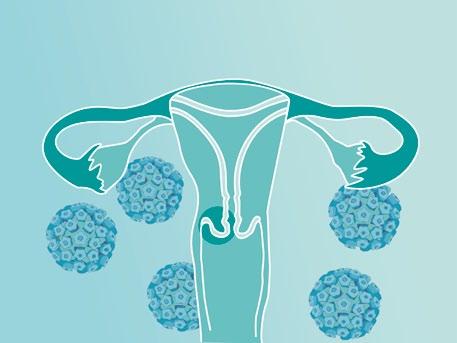 Early Detection of Cervical Cancer.